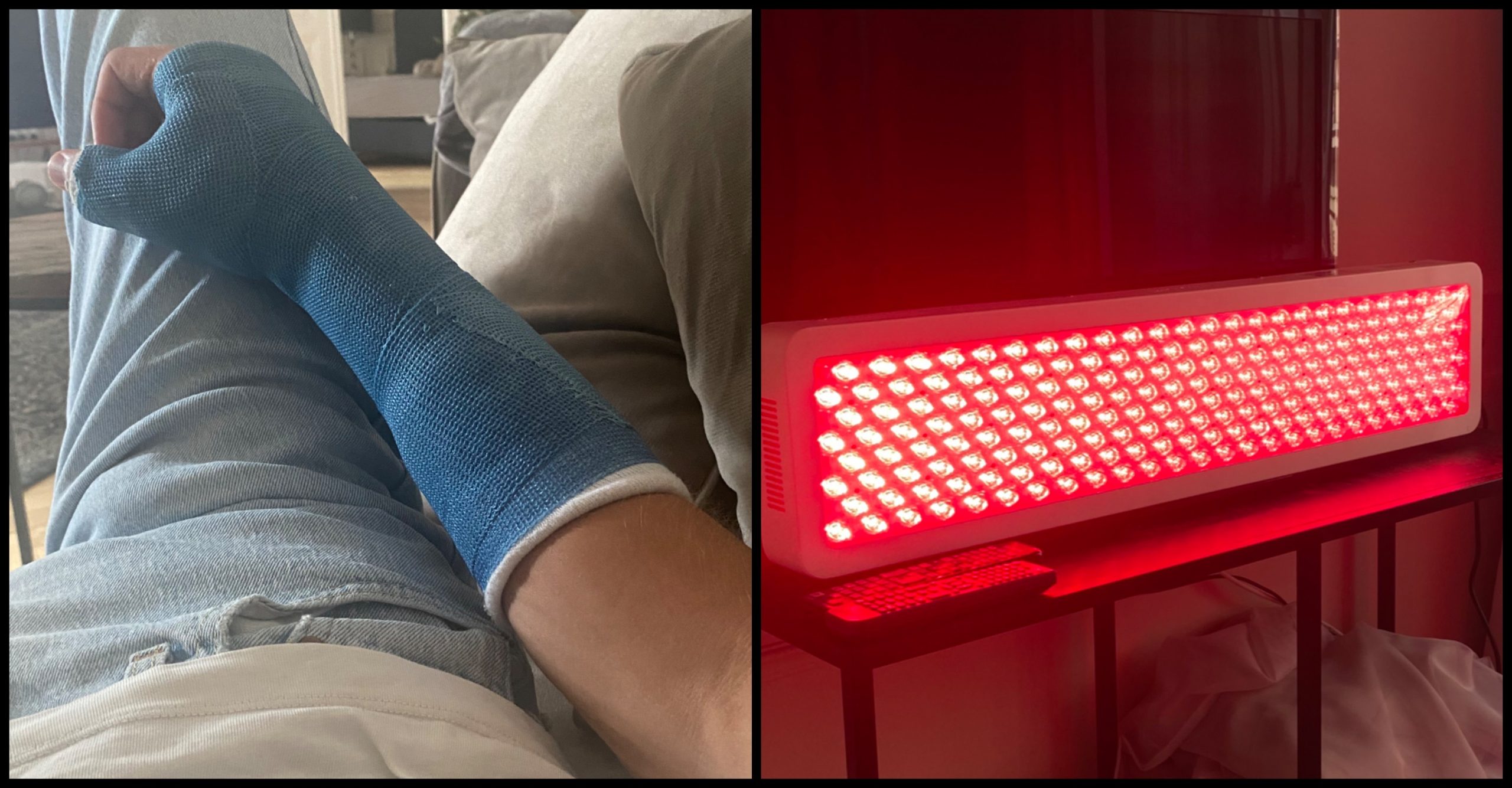 Platre fracture et lumière rouge infrarouge